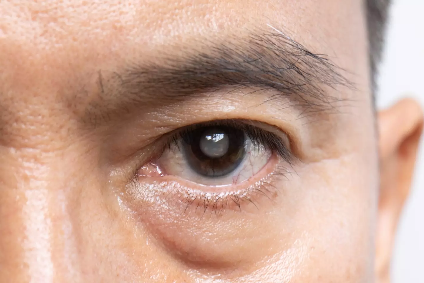 A senior man with cataracts (Getty Images)