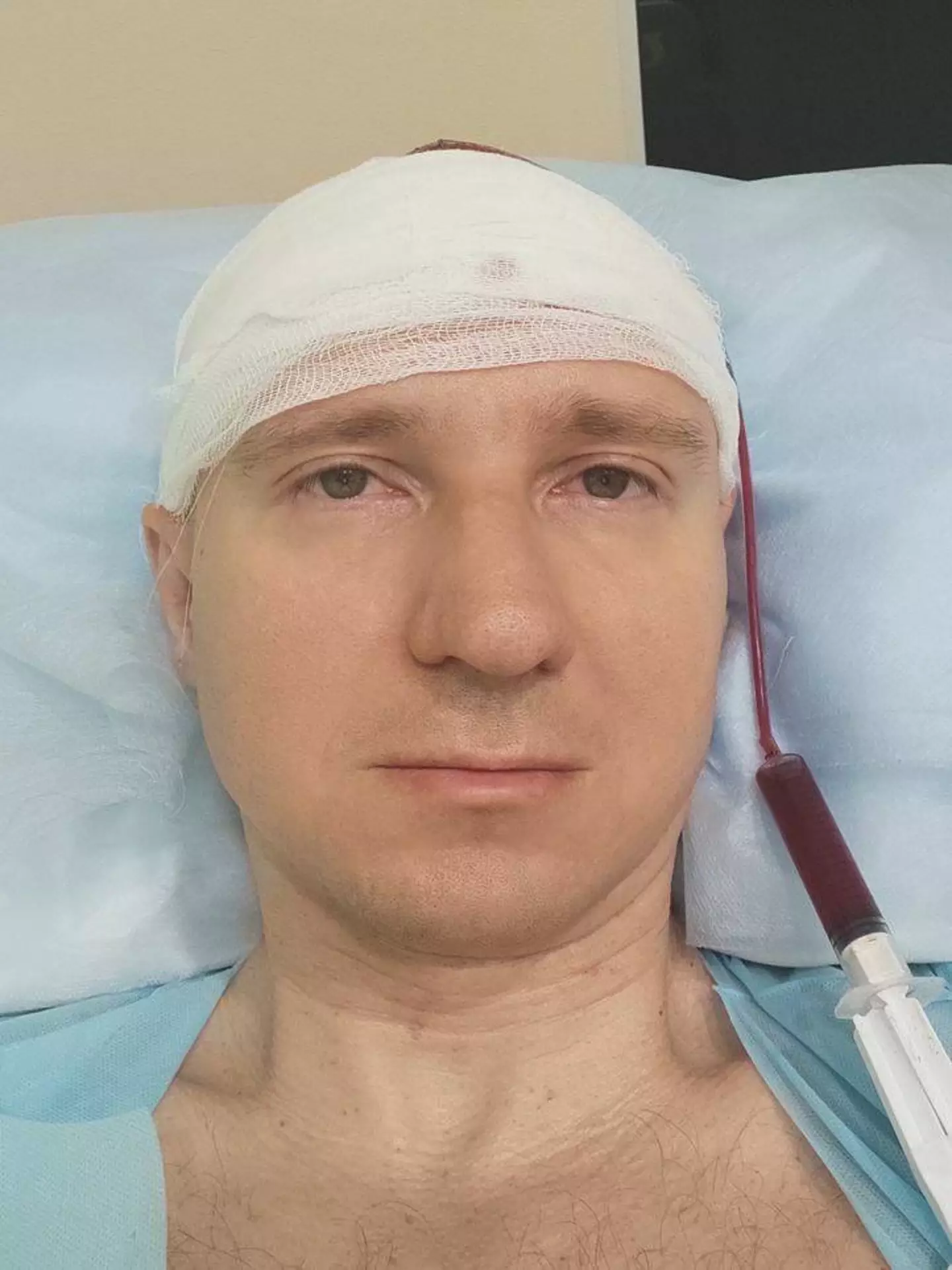 Raduga had his implants removed five weeks after his surgery (X / Michael Raduga)