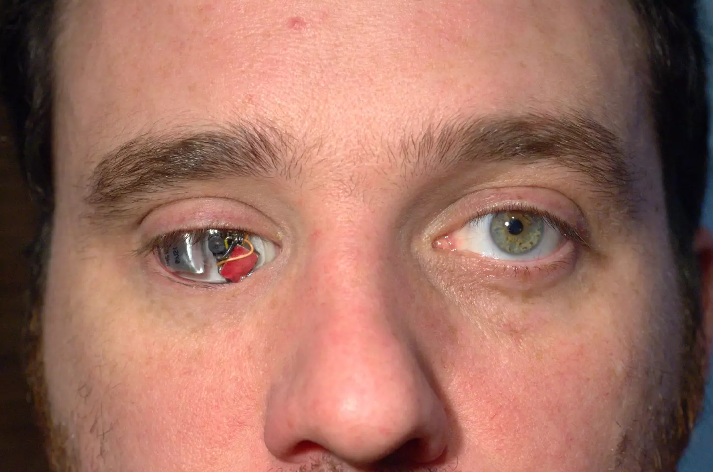 The eye has a tiny circuit board (Rob Spence)