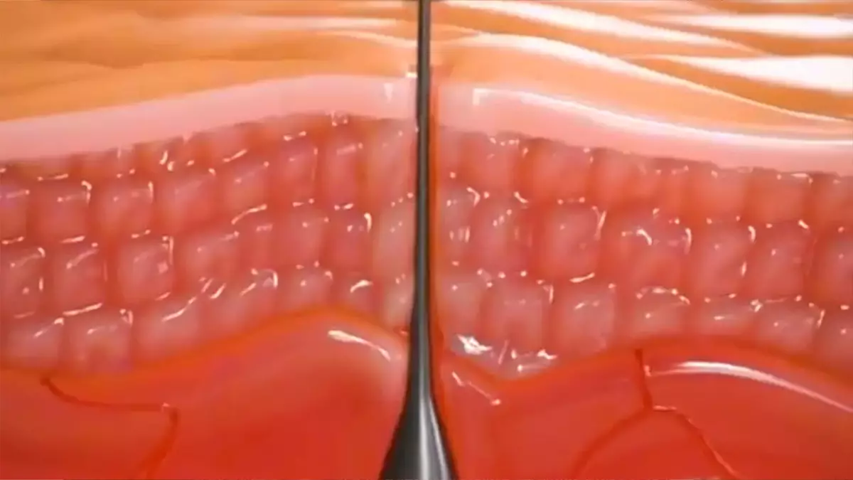 Plucking a hair can lead to further problems (YouTube/@zackdfilms92)