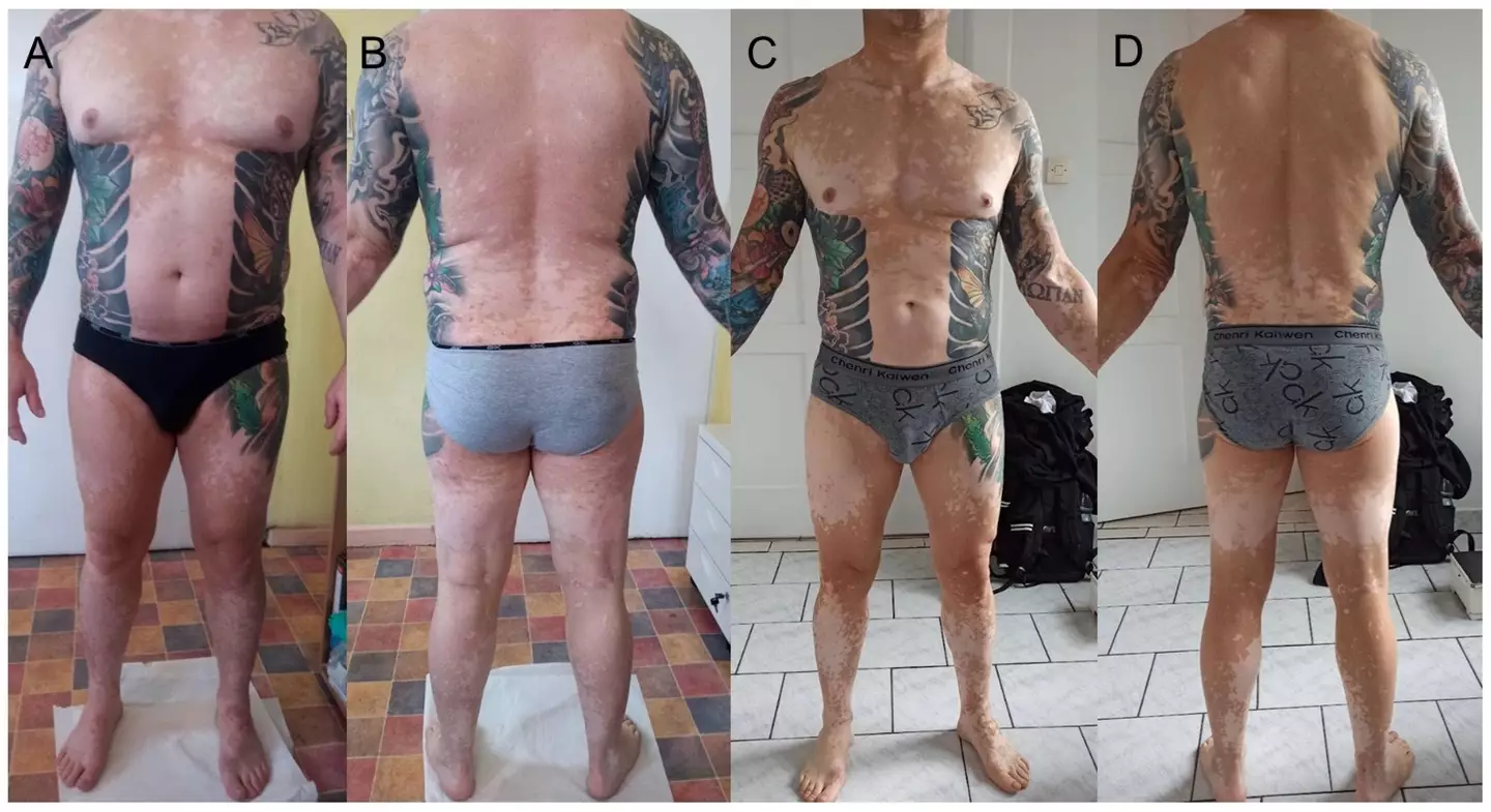 He's been permanently affected by the tattoo (Wroclaw Medical University / Clinics and Practice)