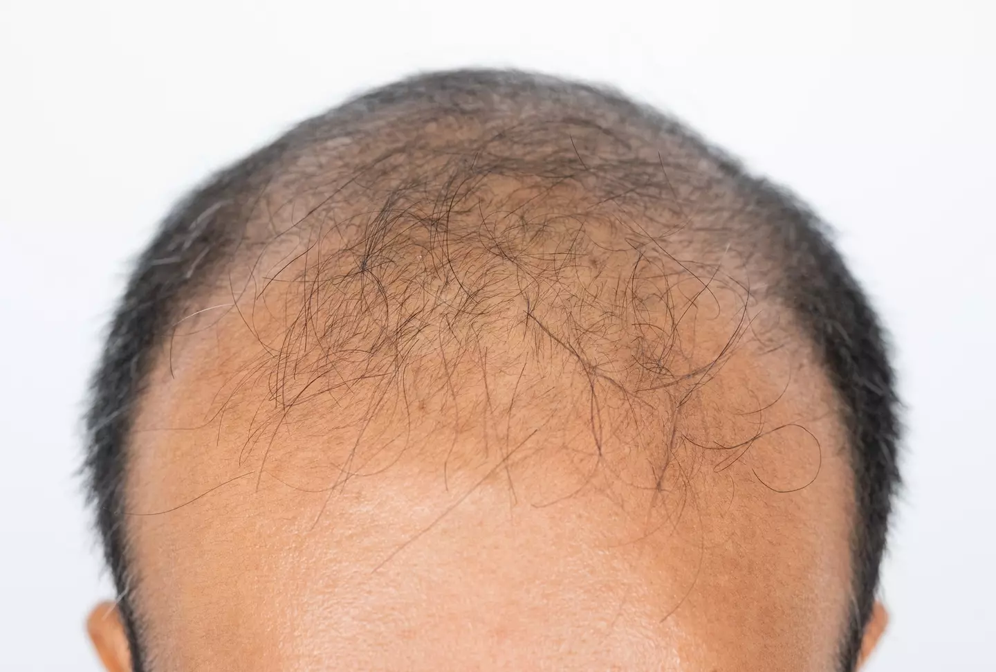 Hair loss is something that most people have to deal with as they age (Getty Stock)
