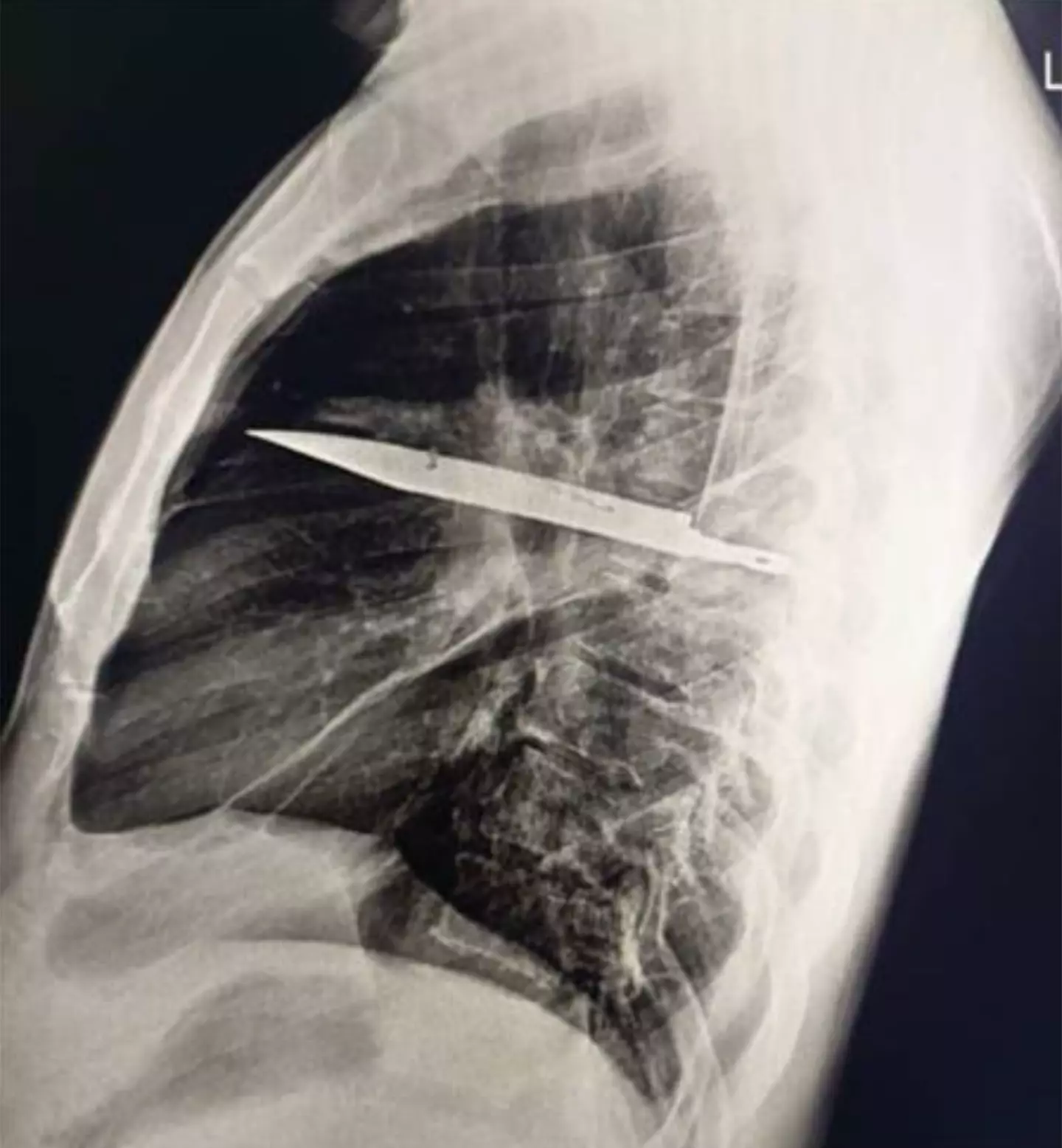 Incredibly, the man wasn’t having any chest pains or trouble breathing (PubMed Central)