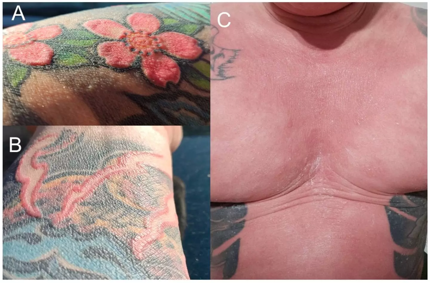 He had to have eight operations to remove the ink (Wroclaw Medical University / Clinics and Practice)