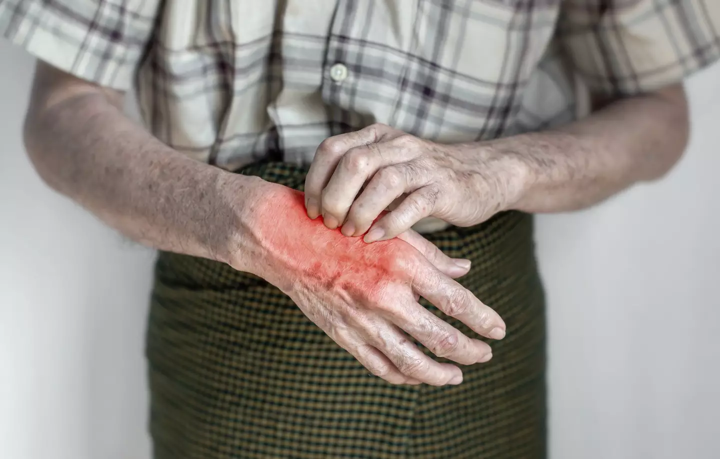 Scabies rashes appear most frequently on the hand but can spread throughout the body, leaving its victim in a nightmarish situation (Getty Stock)