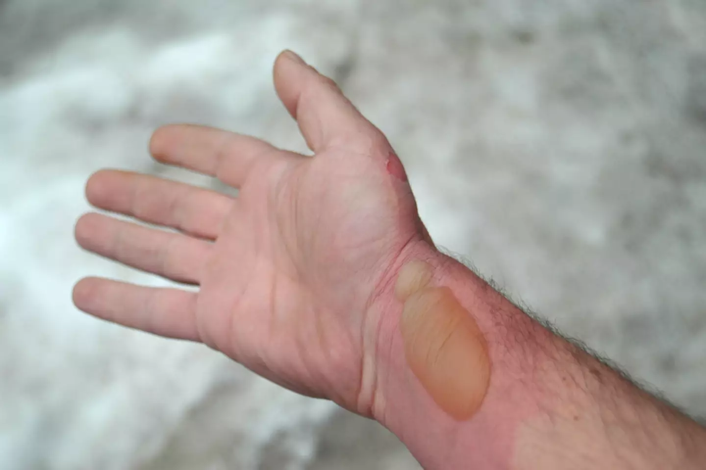 An arm with a large blister formed over a burn (BSIP/Getty Images)