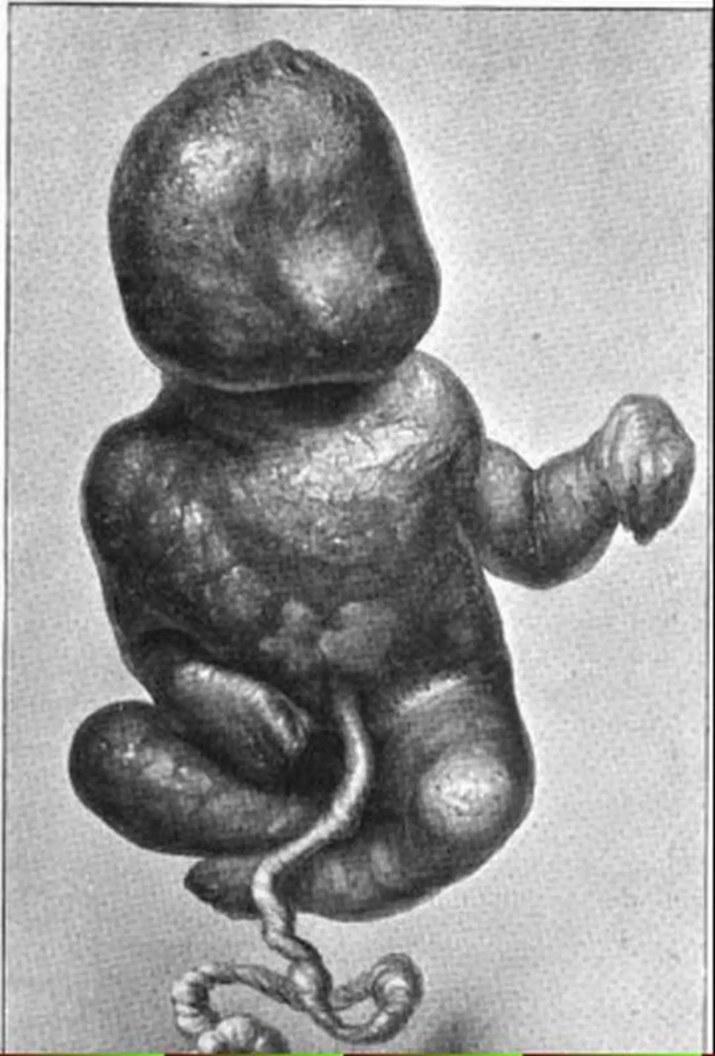 Lithopedion's are an extremely rare phenomenon (John Hopkins Hospital Bulletin Volume 8)