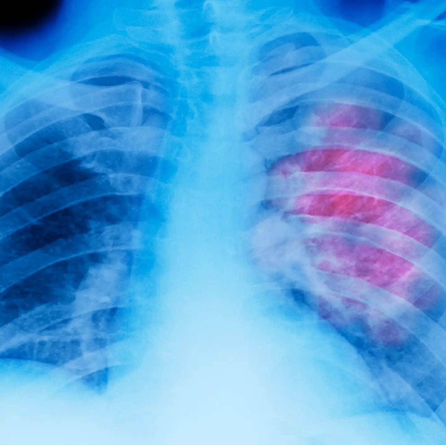 'Groundbreaking' lung cancer vaccine is being developed