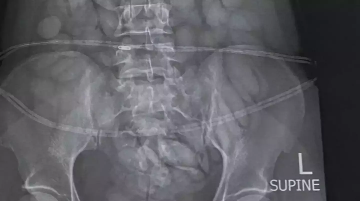An X-ray showed more than 60 pellets of what is thought to be cocaine inside a woman's body (SA Police Services)