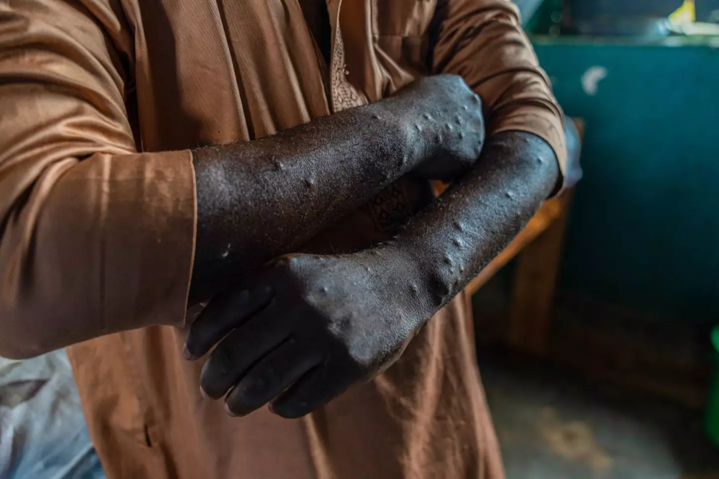 Lesions and blisters across the body are a key symptom of mpox (Glody Murhabazi/AFP via Getty Images)