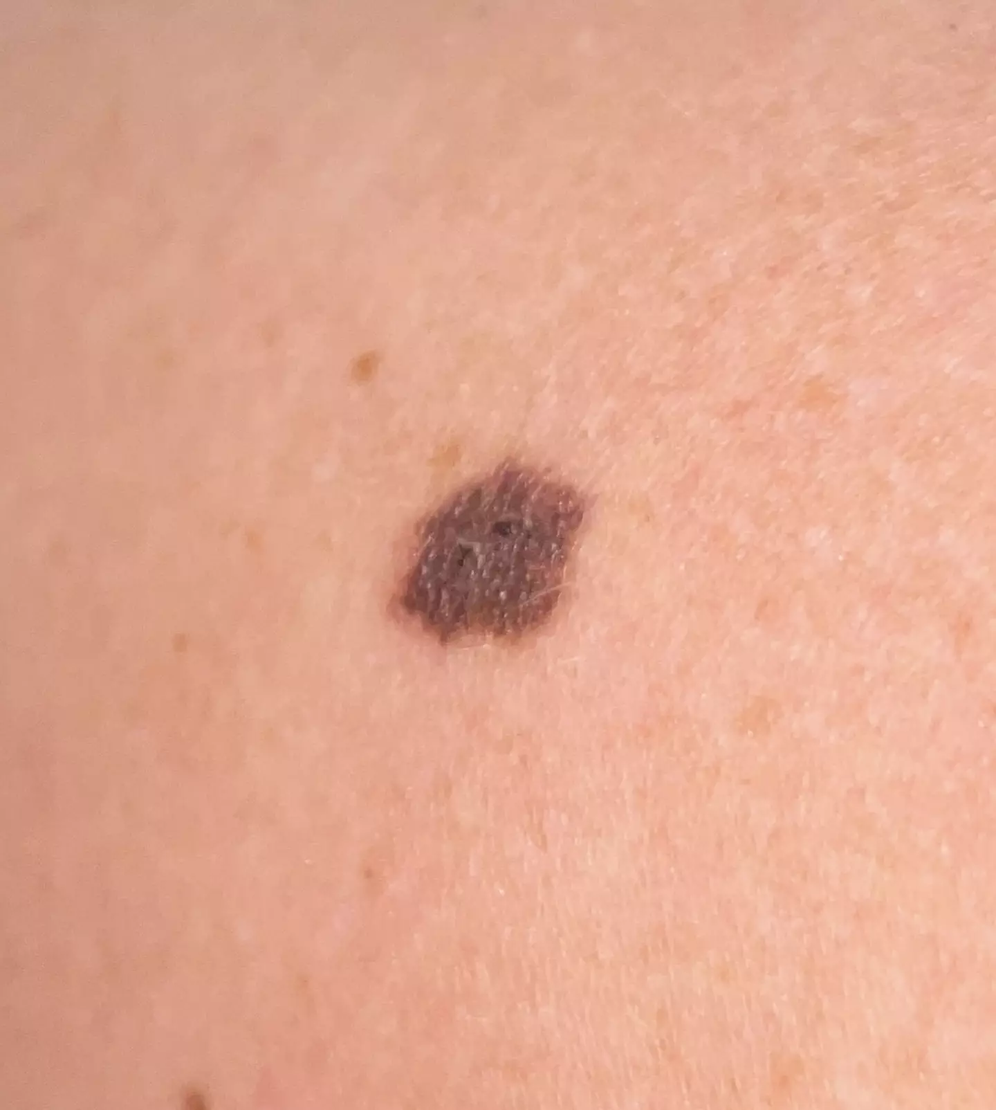 Doctors discovered that the mole was cancerous (Kennedy News and Media)