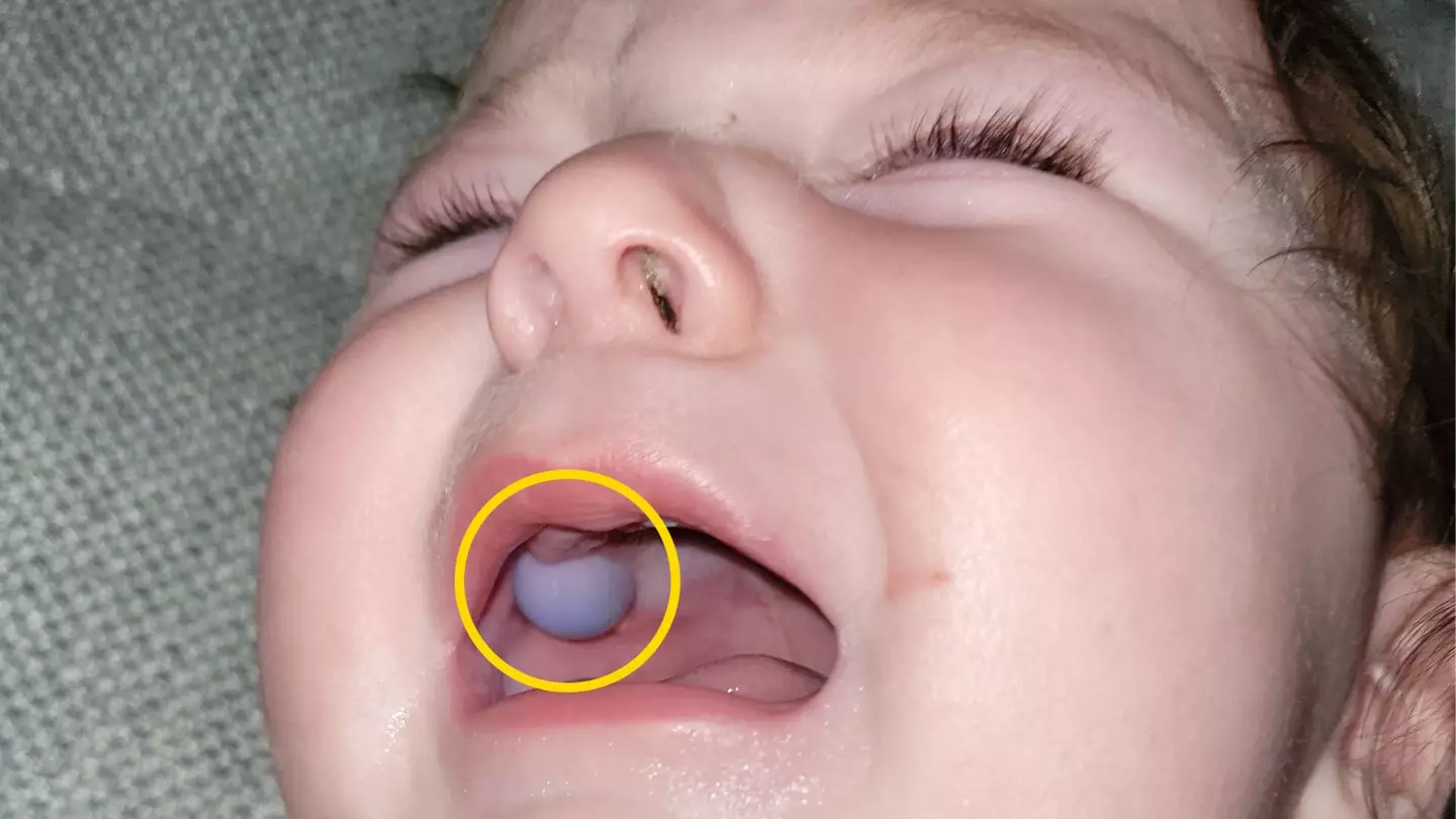 Stunned doctors thought baby had mouth tumour until discovering alarming truth