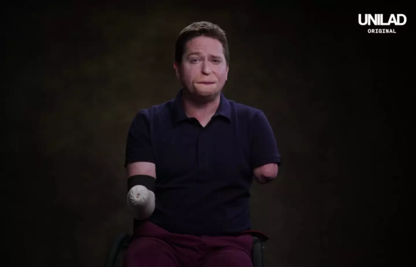 A Brit who thought he had ‘man flu’ ended up losing his limbs and a portion of his face to Strep A.