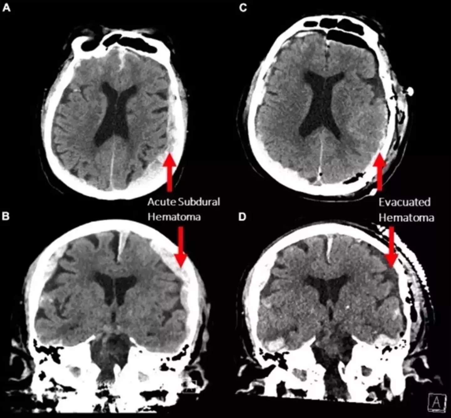 Researchers examined a man's brain in the final moments before death (Frontiers in Ageing Neuroscience)