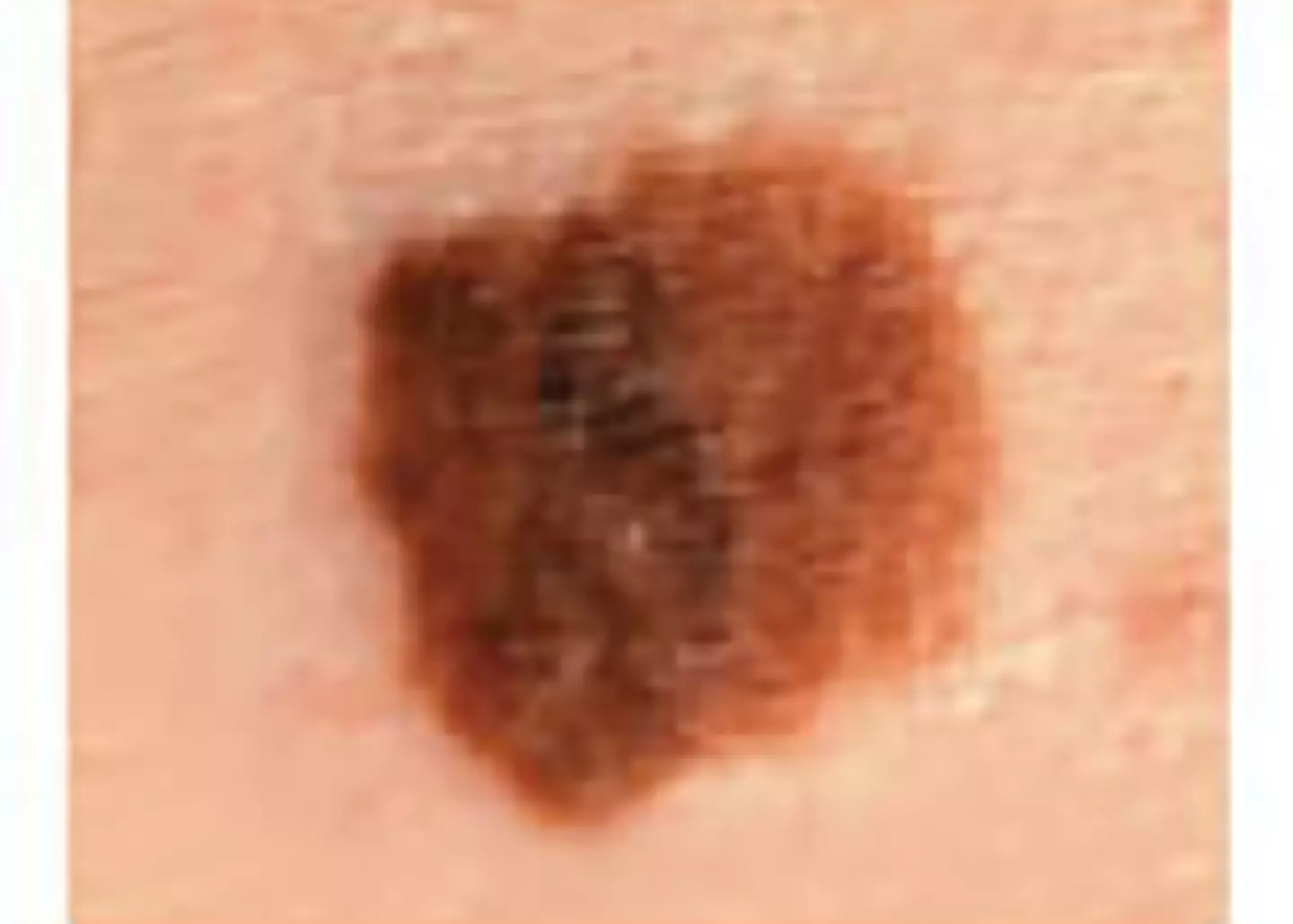 D is for Diameter or Dark (Skin Cancer Foundation)