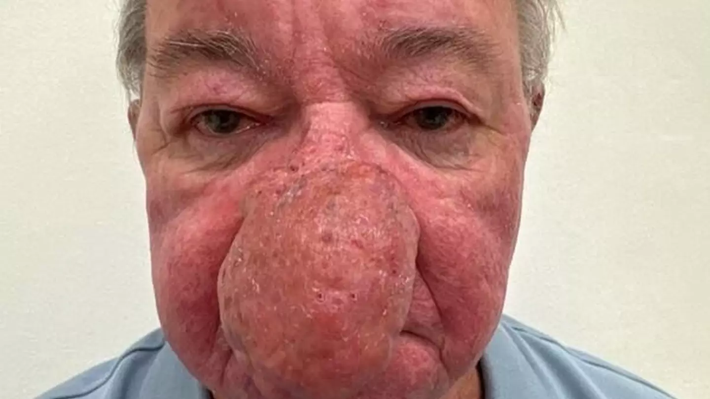 Grandad's heartbreaking statement after condition left his nose so big he couldn't kiss his wife