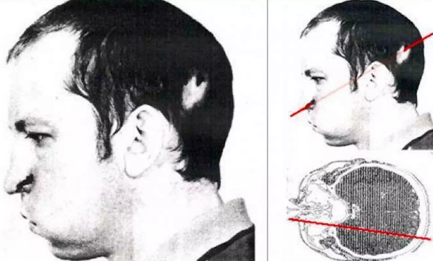 The path the beam took through his head (Public Domain)