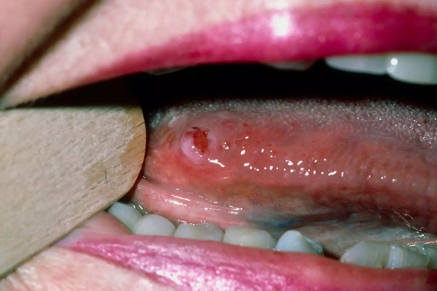 If you have a mouth ulcer that persists for over three weeks you should consult a doctor or dentist (NHS)