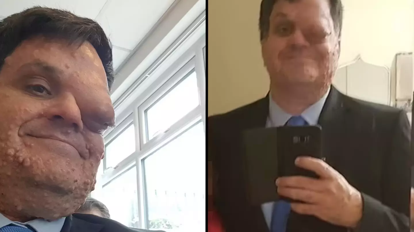 Man claims restaurant threw him out because of facial disfigurement after customers complained