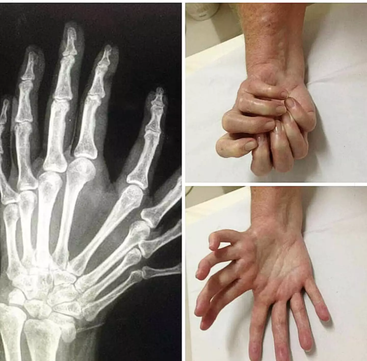 A case of ulnar dimelia.