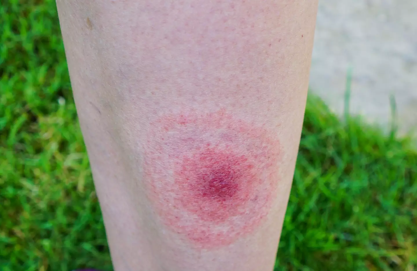 What tick bites can look like from those that are carrying Lyme disease (Getty Stock Images)