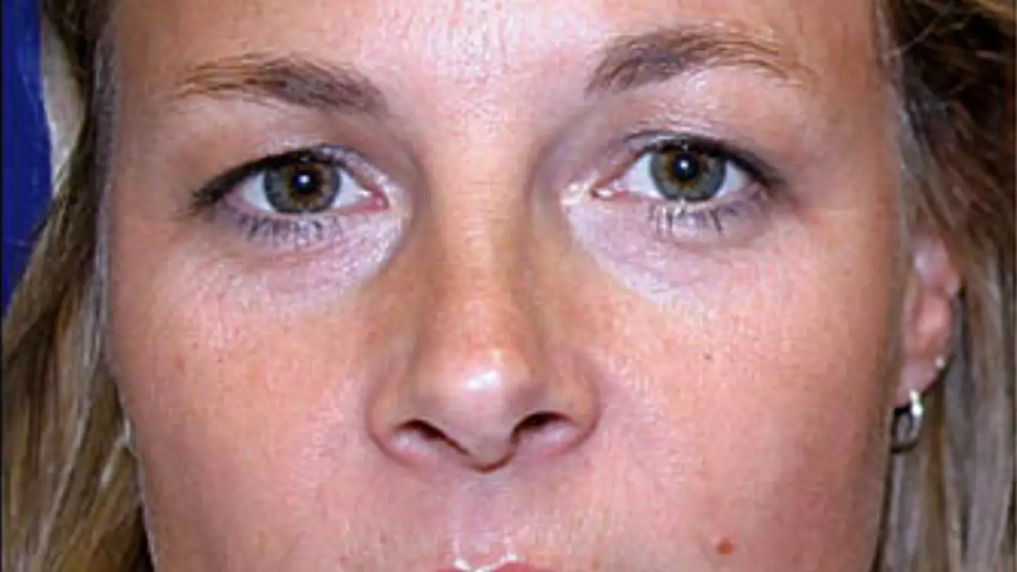 Identical twins shared huge impact after one used botox for 20 years and other didn’t