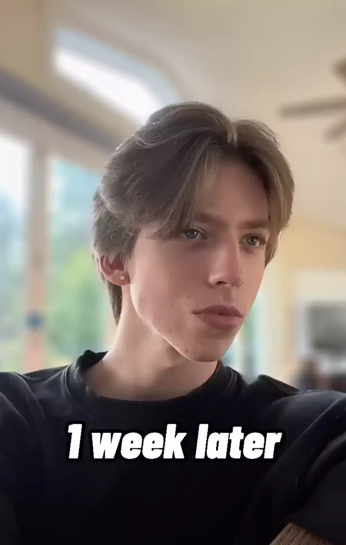 Michael claims his acne cleared up after a week of committing to the routine.