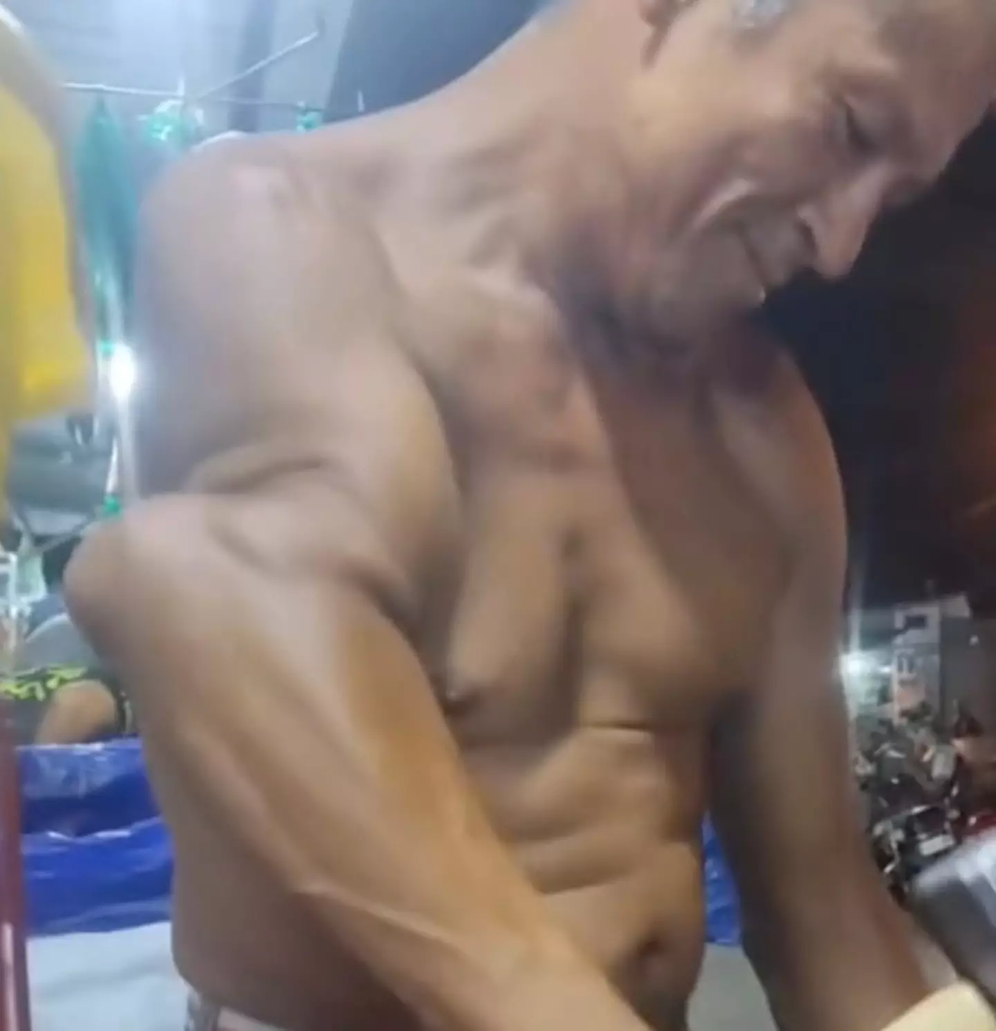 The man has what appears to be a nonunion fracture.