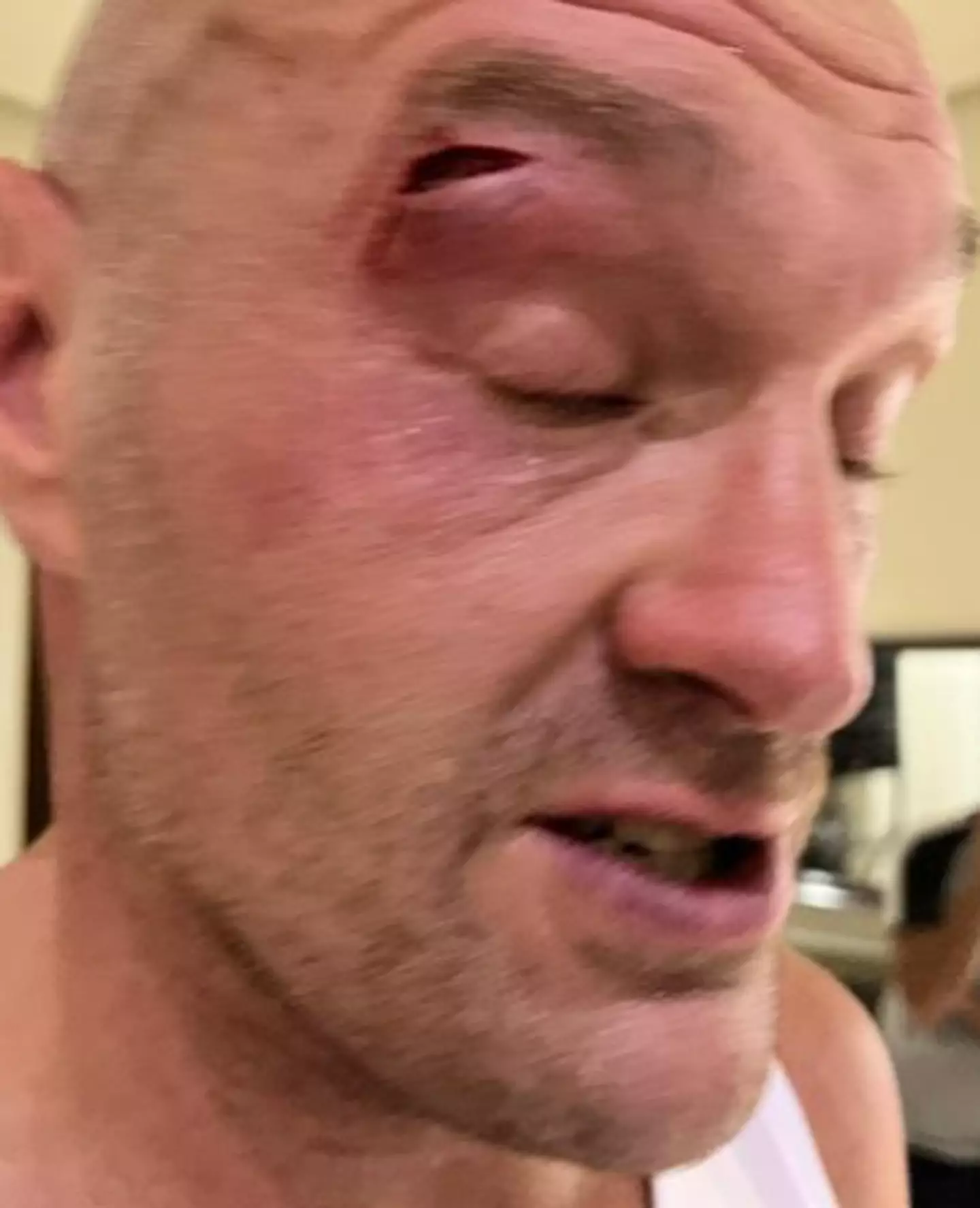 Fury's fight with Usyk has been postponed as a result of him sustaining an injury.