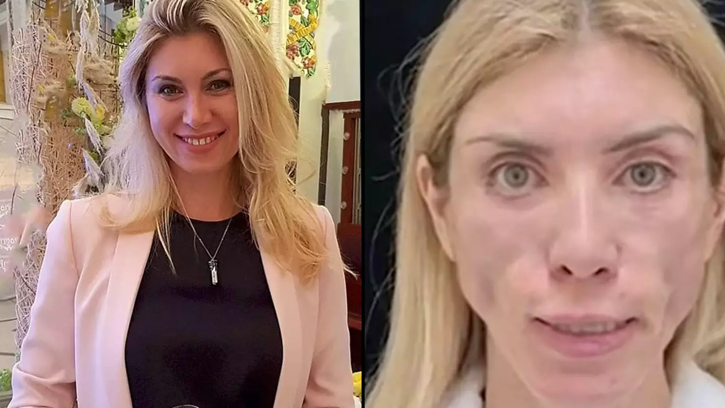 Russian Beauty Queen Claims She Was Unable To Close Her Eyes Or Smile After Plastic Surgery