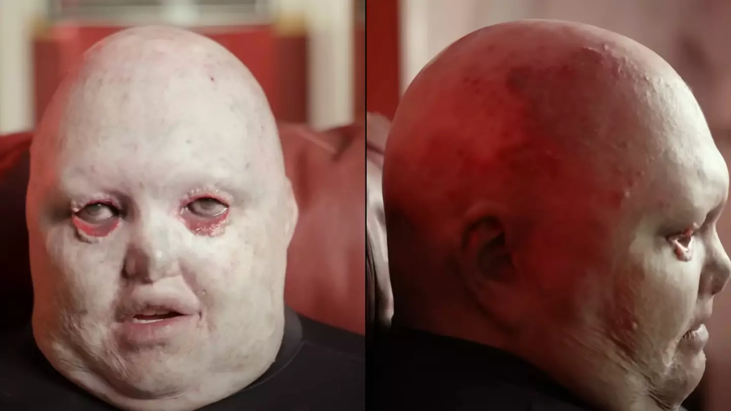 Man in constant pain due to rare condition that should have killed him praised for being 'superhuman'