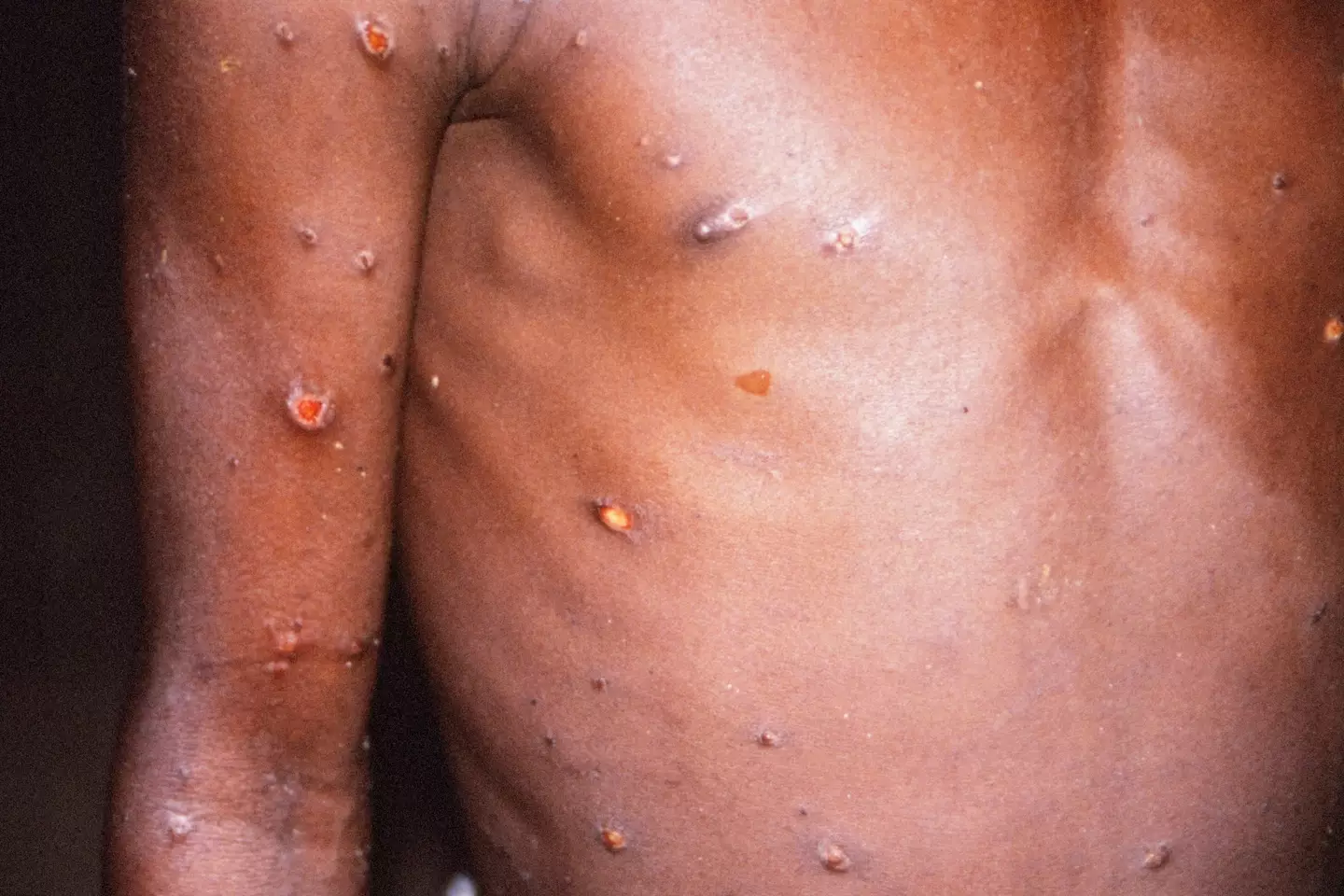 Monkeypox can spread via close contact.
