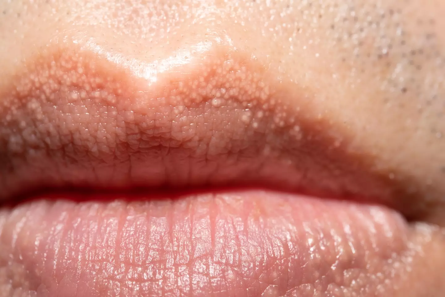 Fordyce spots on the lips (Getty Stock Image)