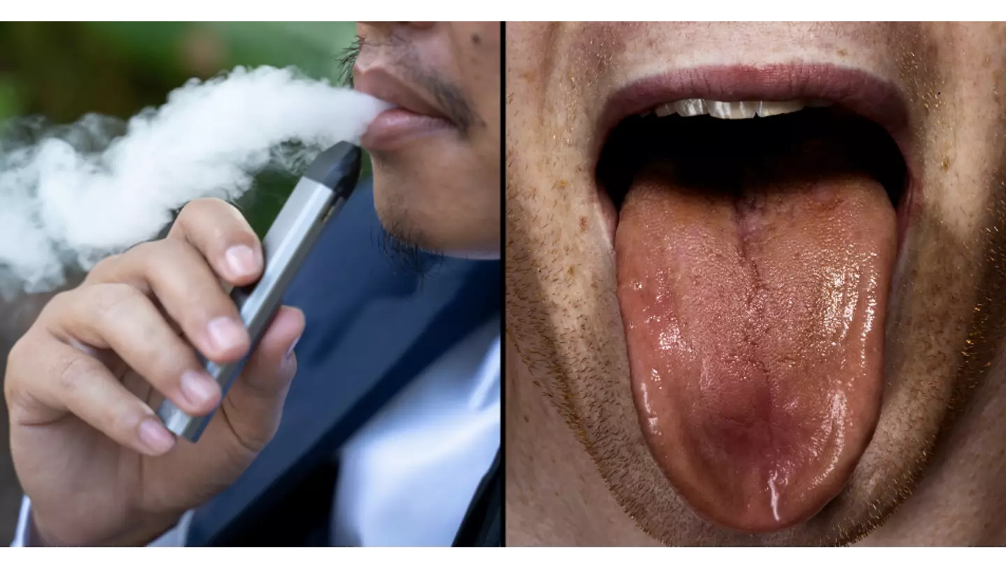 Dentist issues warning over ‘Vaper’s Tongue’ this Christmas