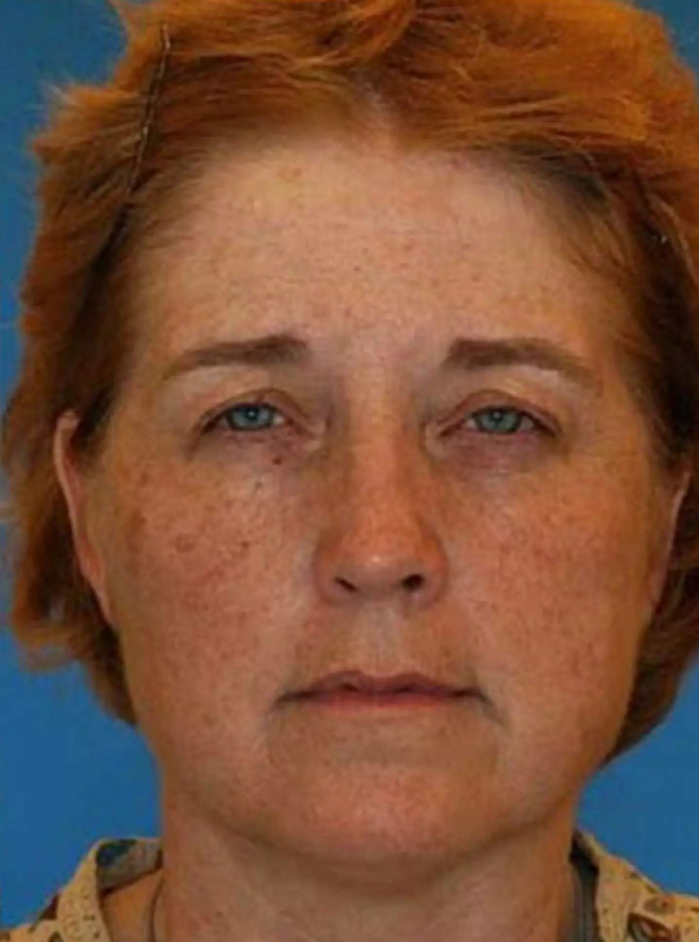 This is the twin who didn't smoke (American Society of Plastic Surgeons / Dr. Bahman Guyuron)