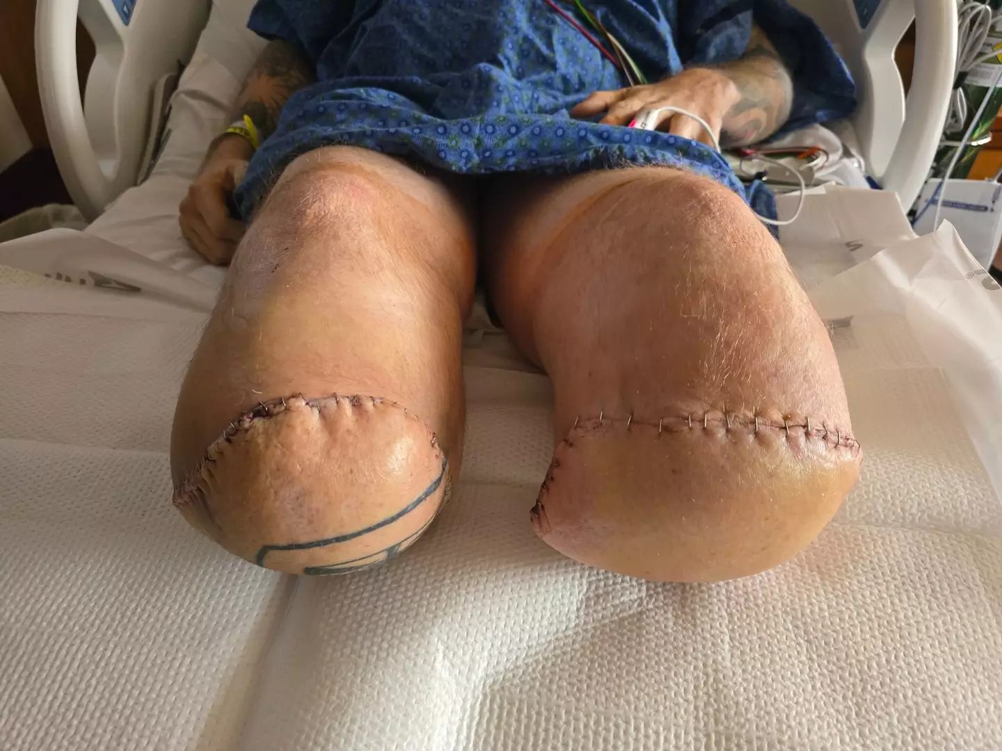 He had to have both of his lower legs amputated after sepsis ate away at them (SWNS)