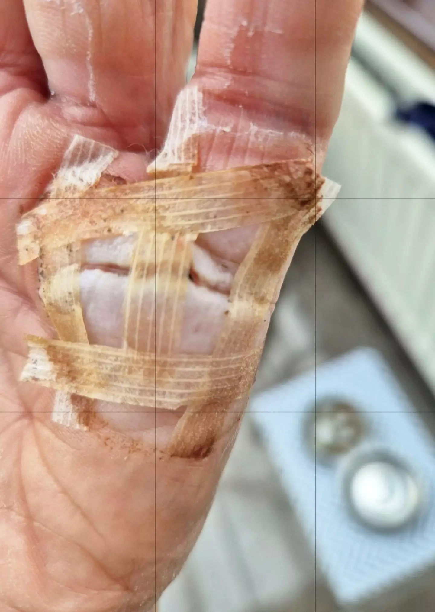 Elizabeth was left needing surgery (SWNS)