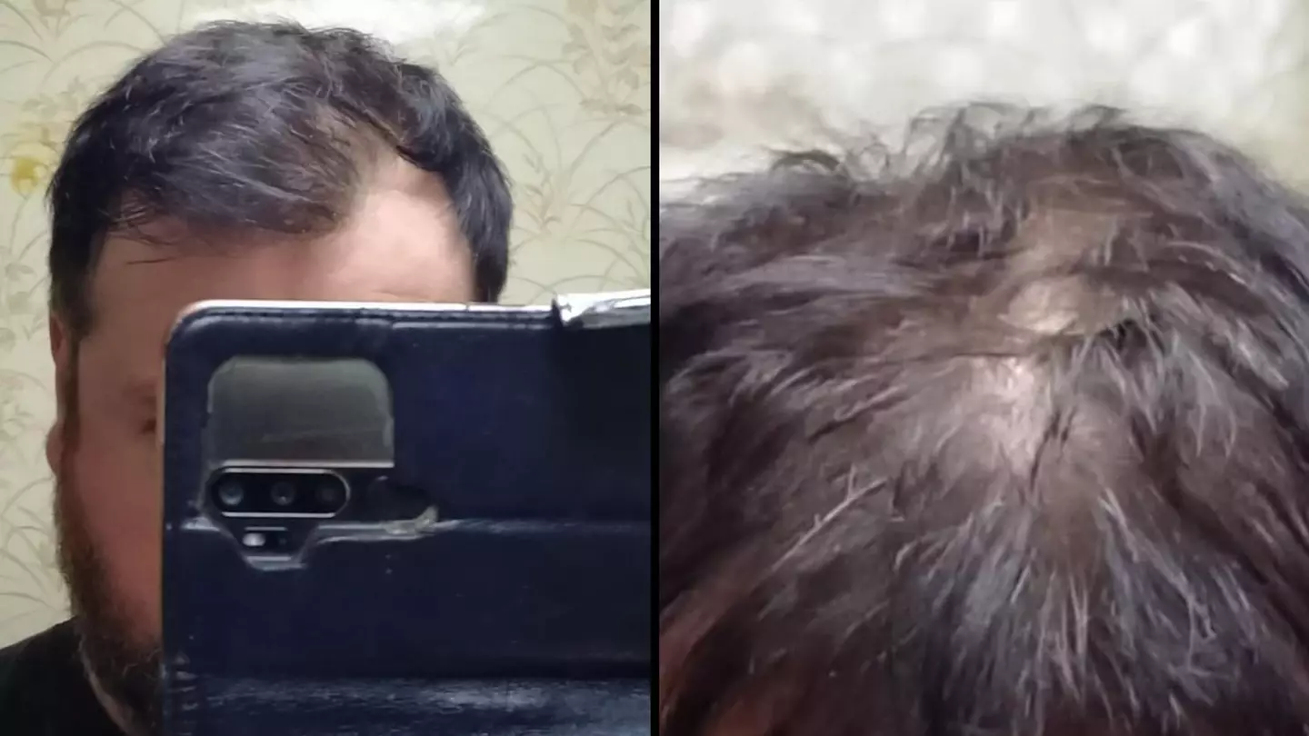 Men are raving about 'brilliant' product that 'slows down hair loss' in 'less than 30 days'