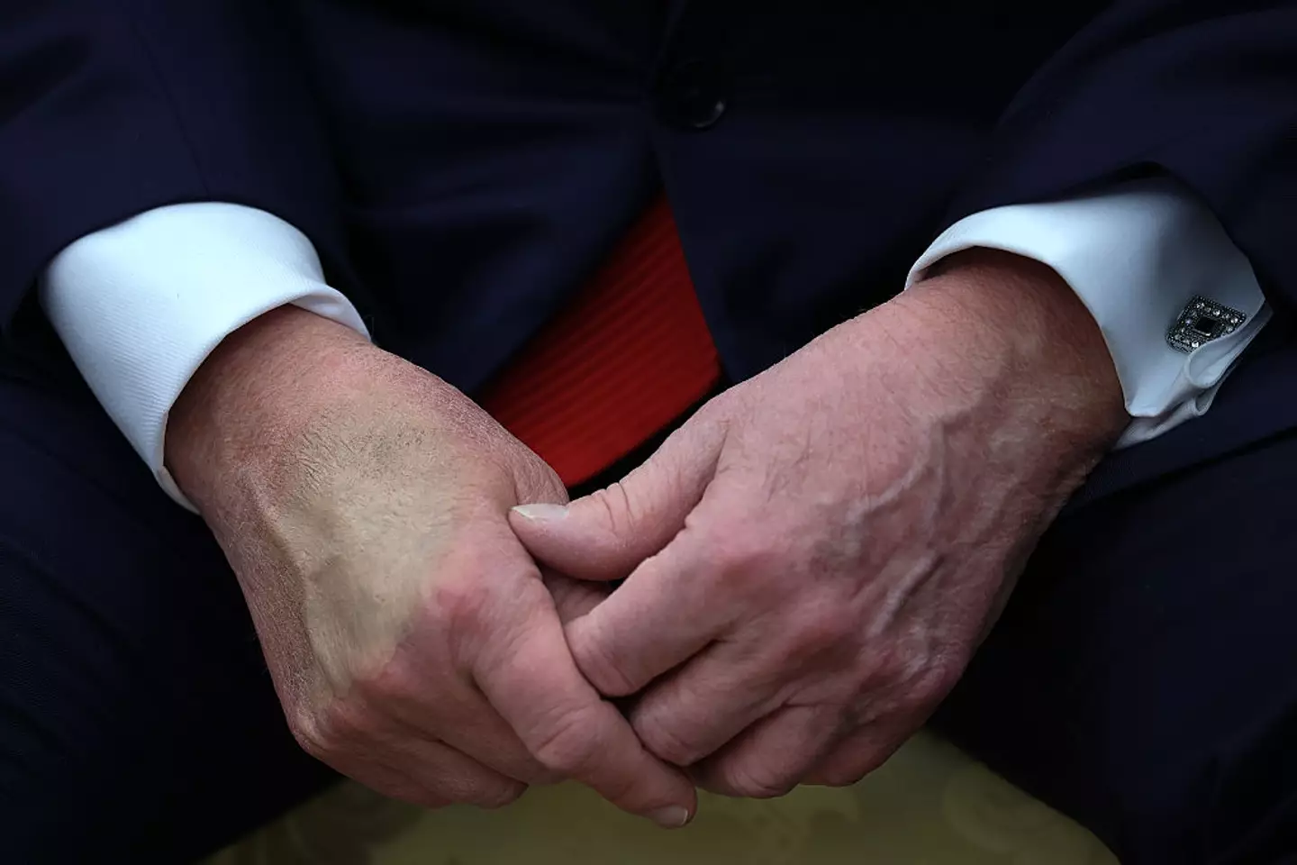 A bruise was also seen on the palm of his hand (Win McNamee/Getty Images)
