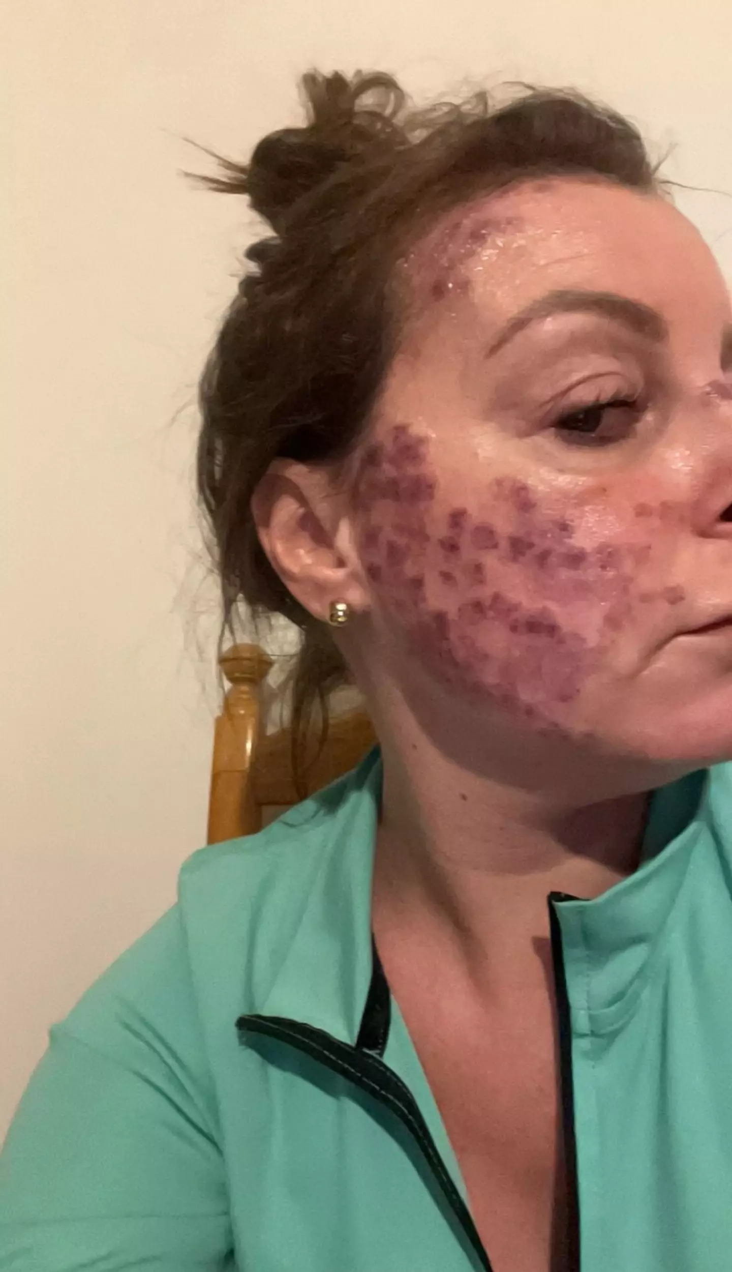 The mum is now undergoing laser therapy after being left with broken capillaries due to cancer treatment.
