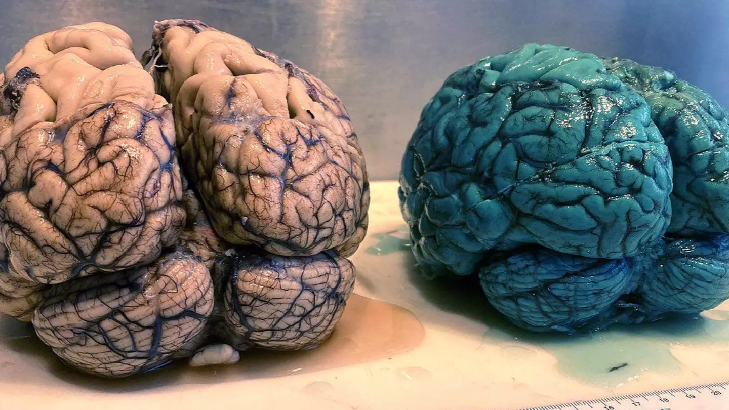 Doctor reveals patient's brain turned blue after taking 'limitless pill' that's gone viral on TikTok
