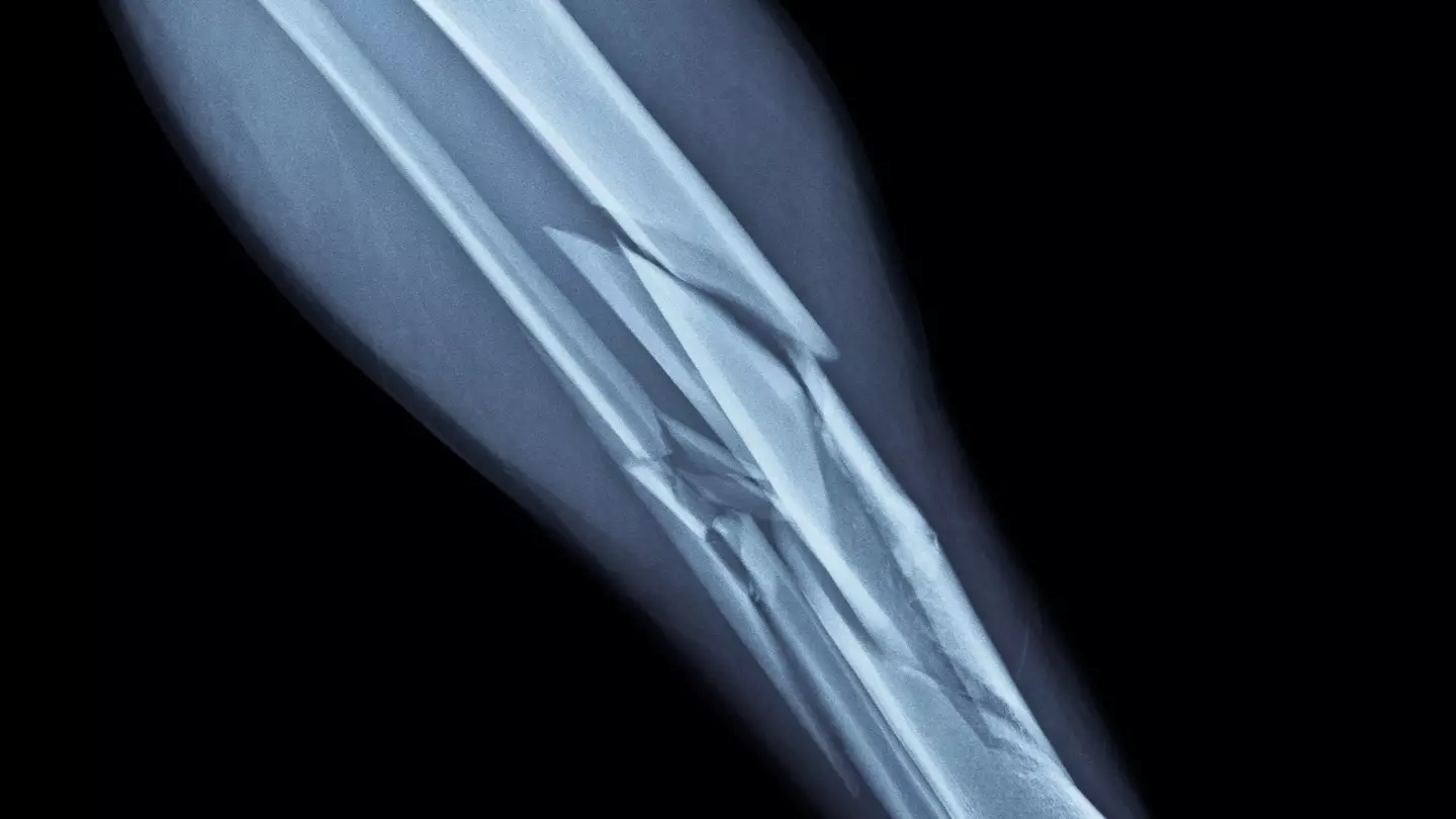 What happens if you break a bone as an adult vs as a kid as strange theory emerges