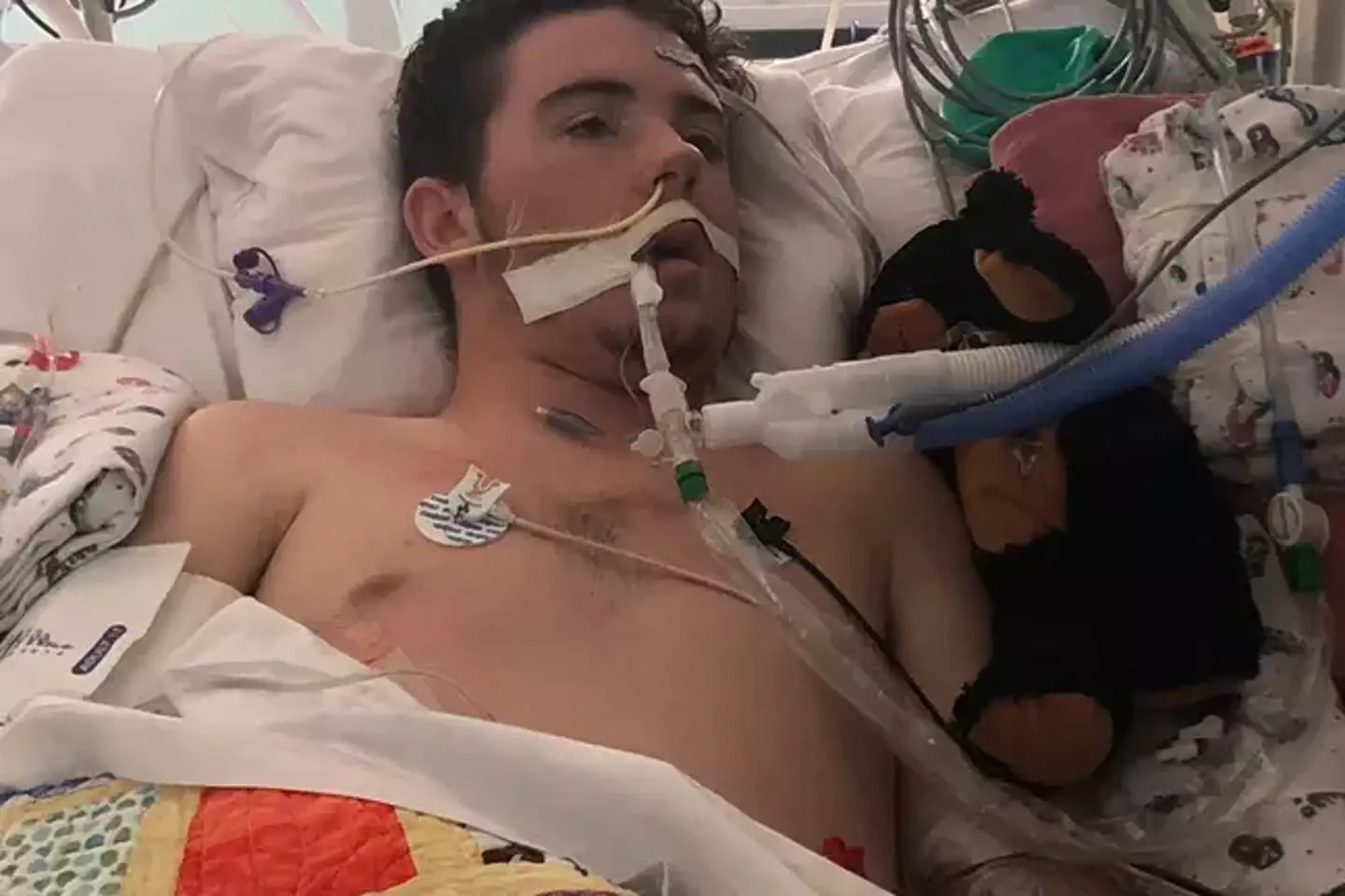 A 17-year-old vaper from Texas was hospitalised for weeks due to lung failure.