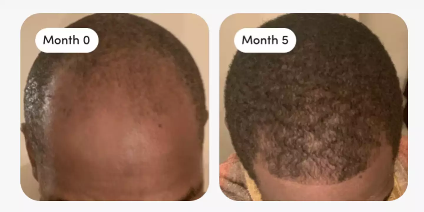 Some customers say they saw results in 'three months' (HIMS)