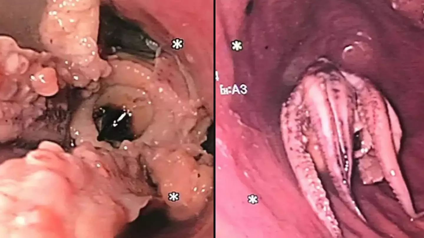 Man complained for days about struggling to swallow had creature pulled out of throat by doctor