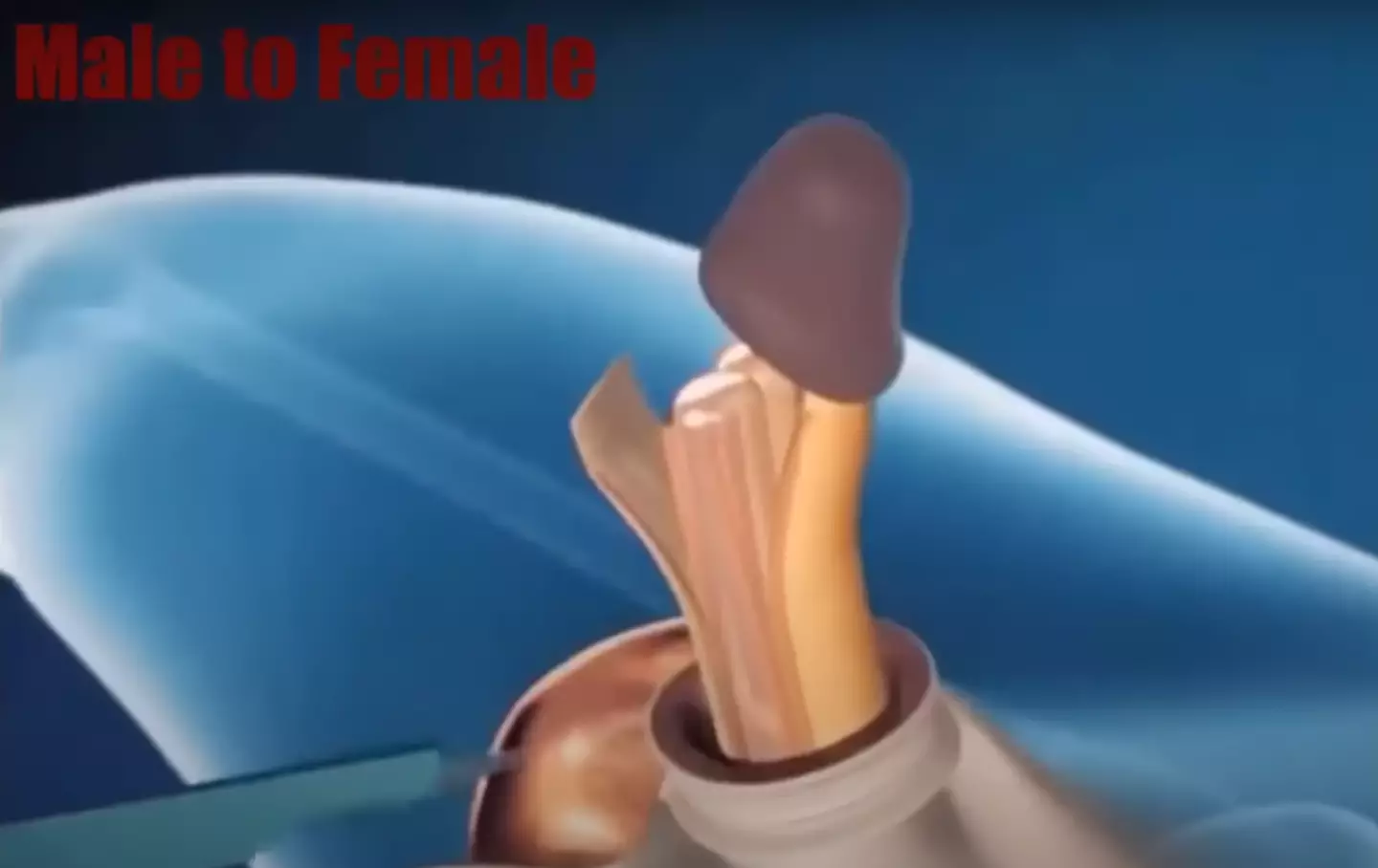 The head of the penis is used to make a clitoris.