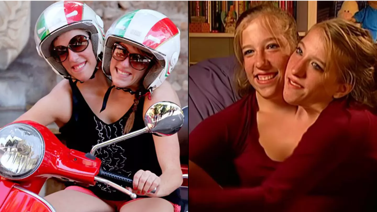 Conjoined twin is now married after parents decided against separation at birth