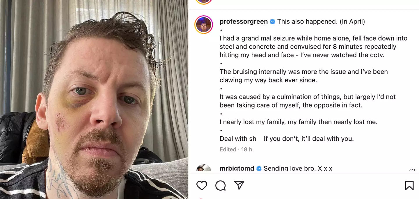 Green showed his bruised face on Instagram.