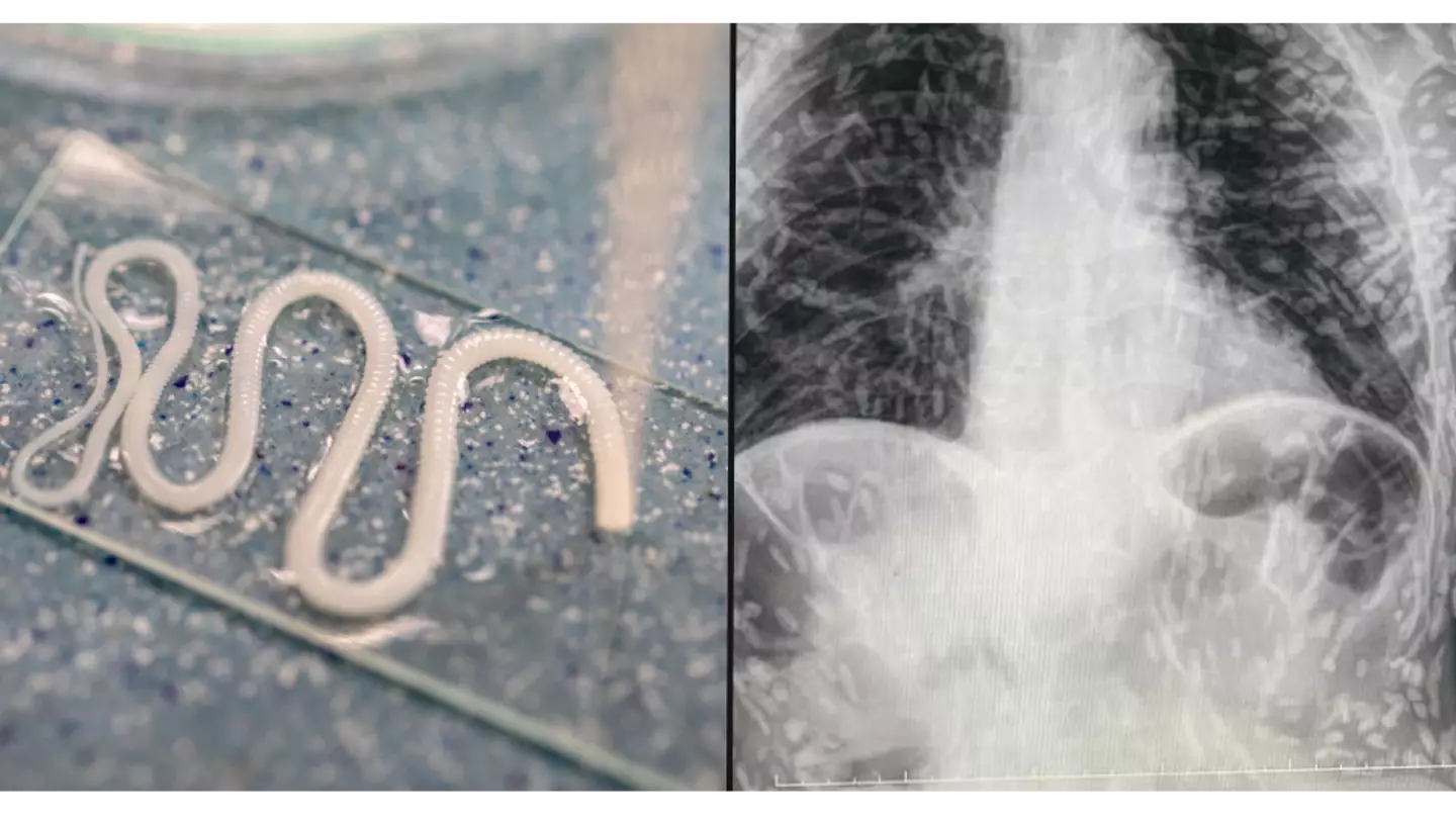 Man who went to hospital with cough shocked to discover he’s swarming with tapeworms