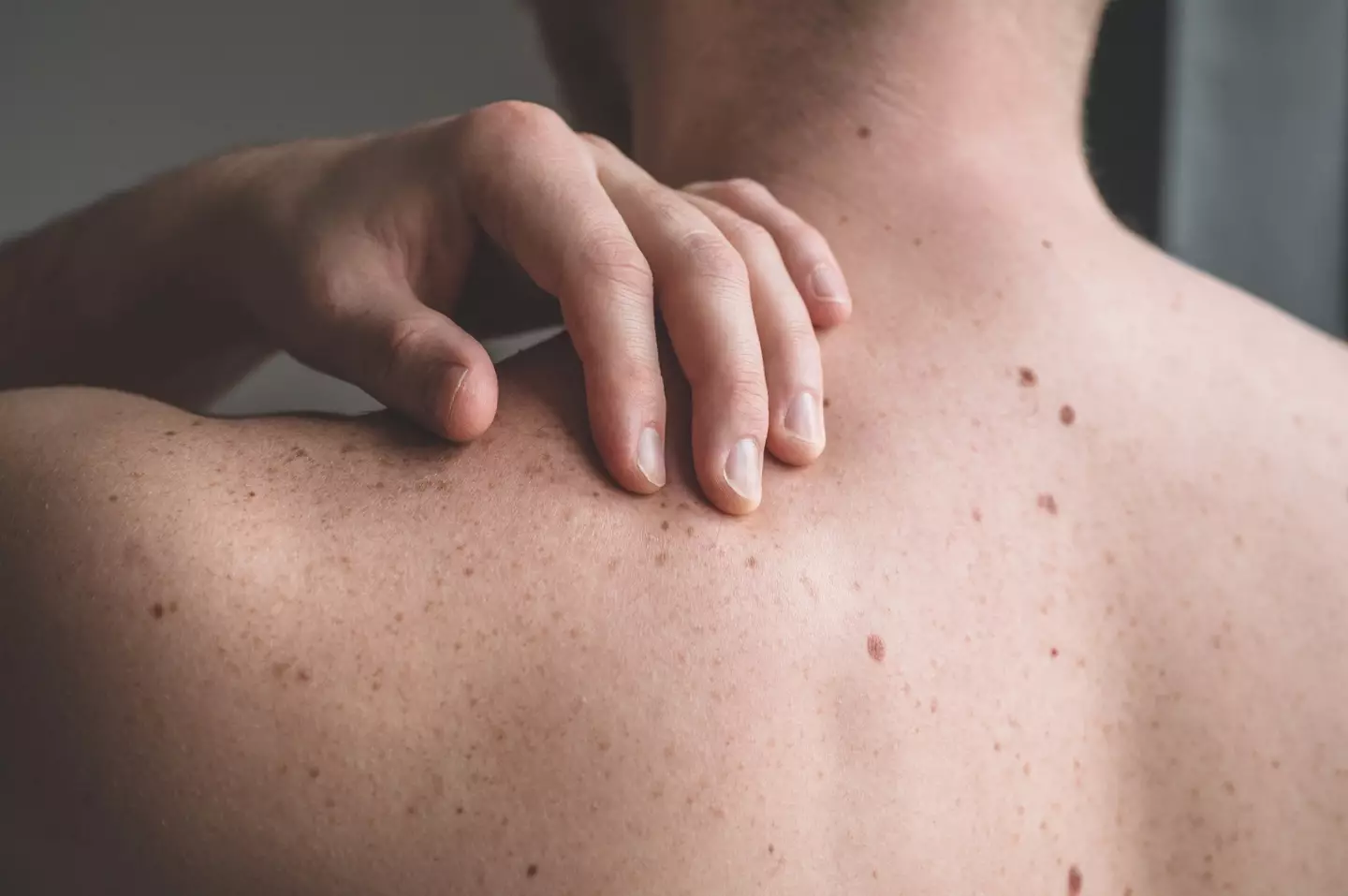 Keep an eye on whether your moles change in size, shape or colour (Getty Stock Image)